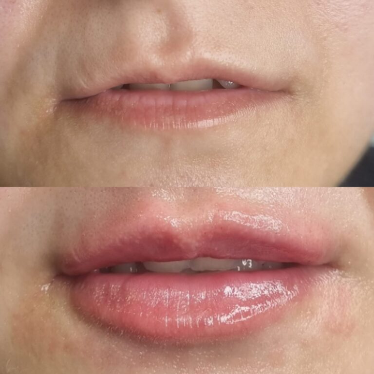 Înainte și după injectarea buzelor subțiri cu acid hialuronic – caz Top Skin