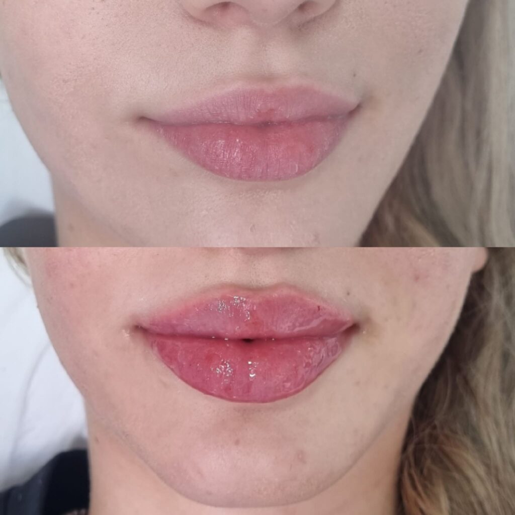 Înainte și imediat după injectarea buzelor cu acid hialuronic – rezultat real Top Skin, definire feminină