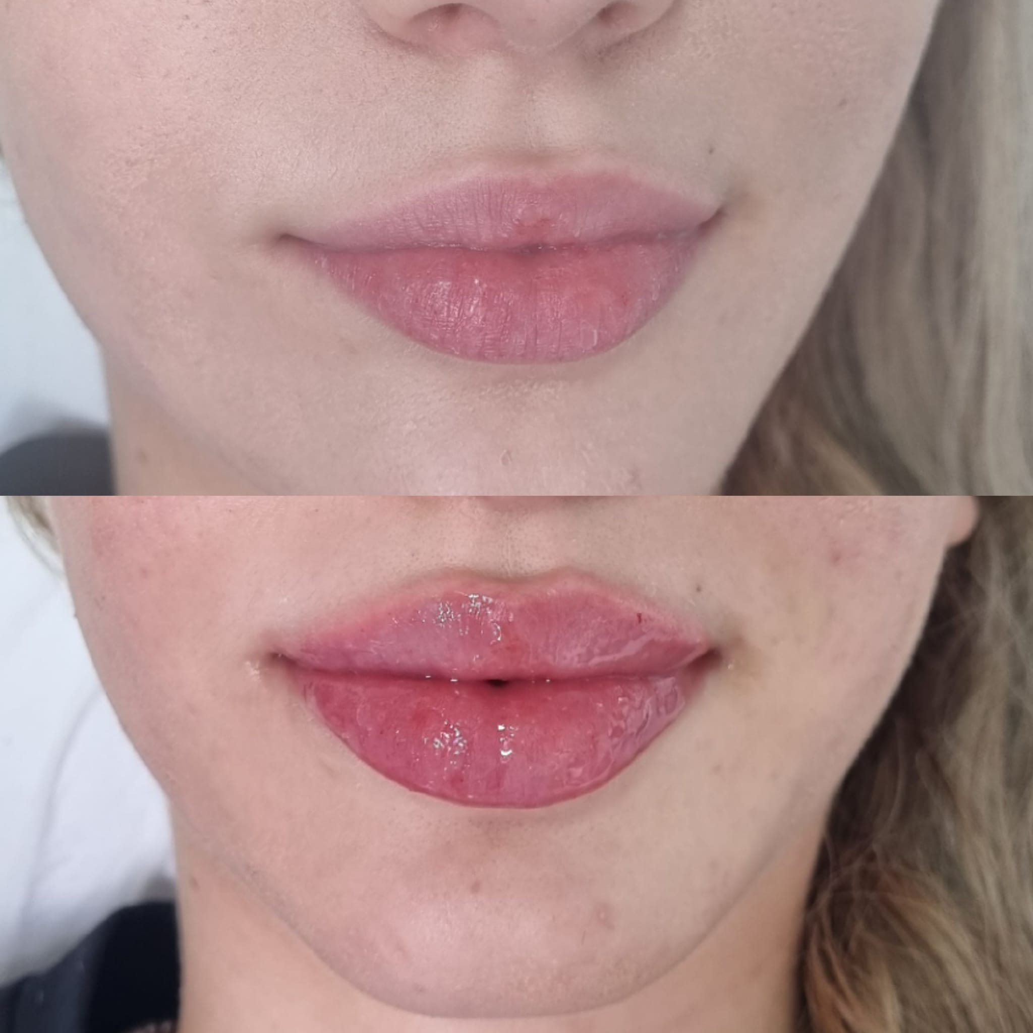 Rezultat real definirea buzelor cu acid hialuronic – Top Skin București