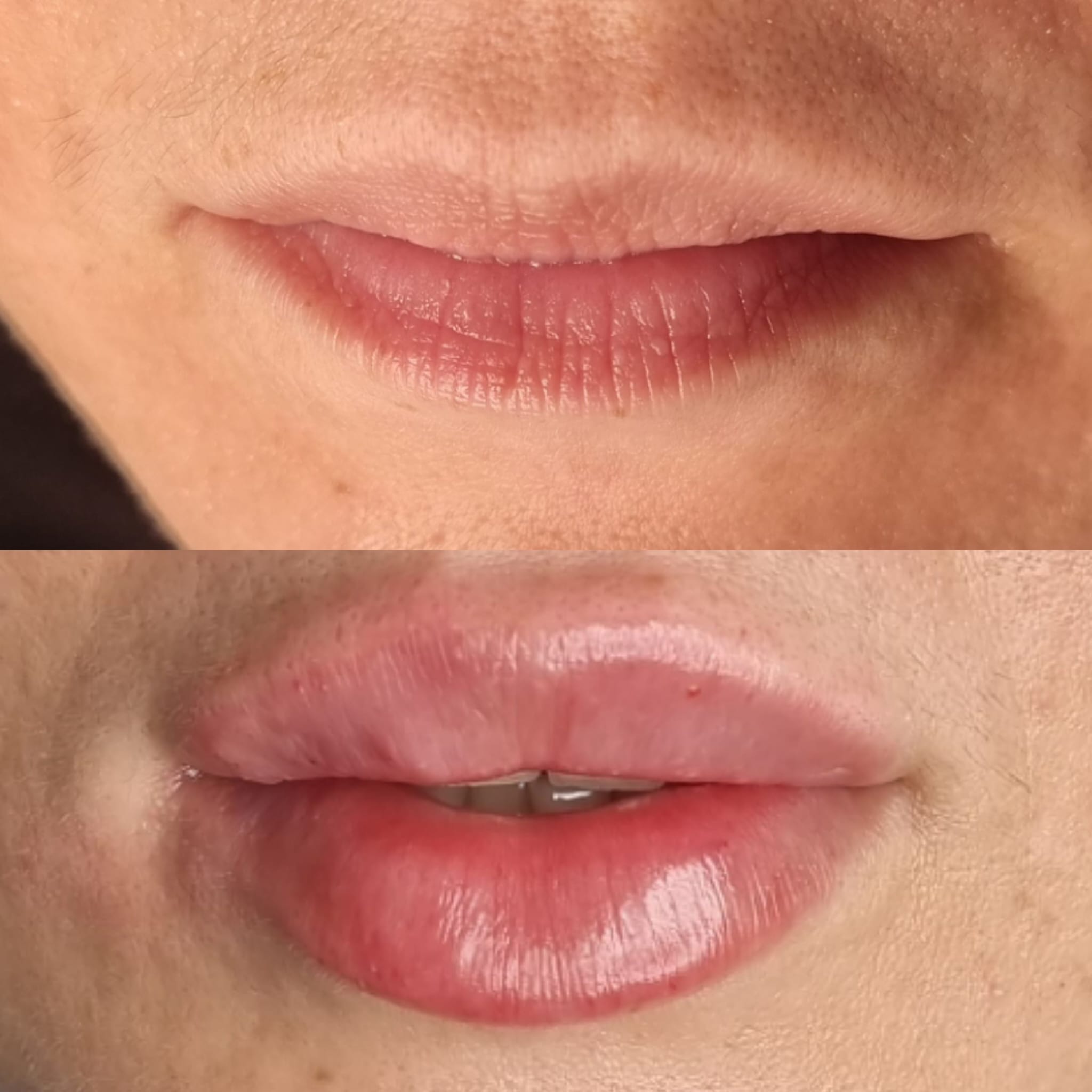 Rezultat real volum și definire buze cu acid hialuronic – Dr. Roxana Chelaru