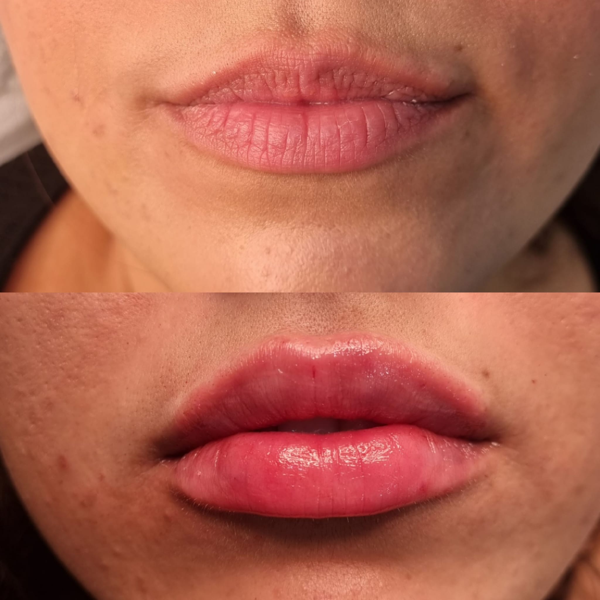 Rezultat real mărire buze cu acid hialuronic – Top Skin Sector 2 București