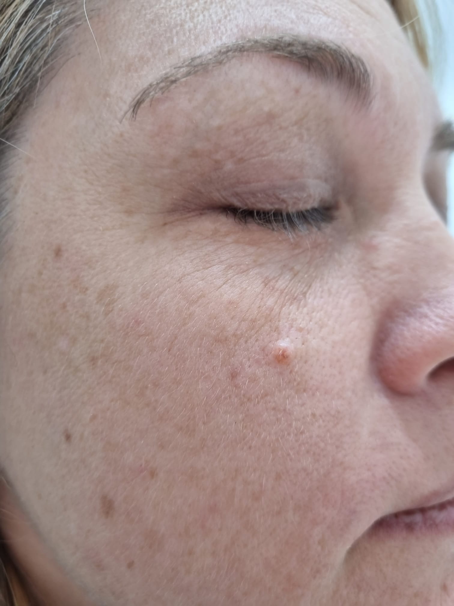 Pleoapă la două săptămâni după îndepărtarea papiloamelor cu Laser CO2 la TopSkin București