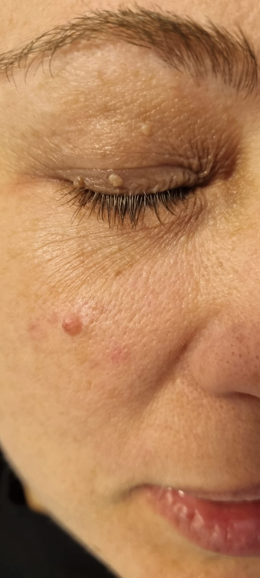 Papiloame palpebrale înainte de tratamentul cu Laser CO2 la TopSkin București