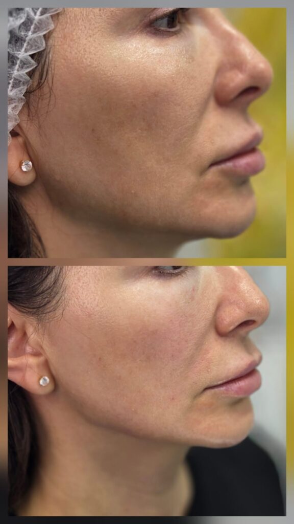 Profil înainte și după corectarea mentonului și jawline cu 3 ml la Top Skin București