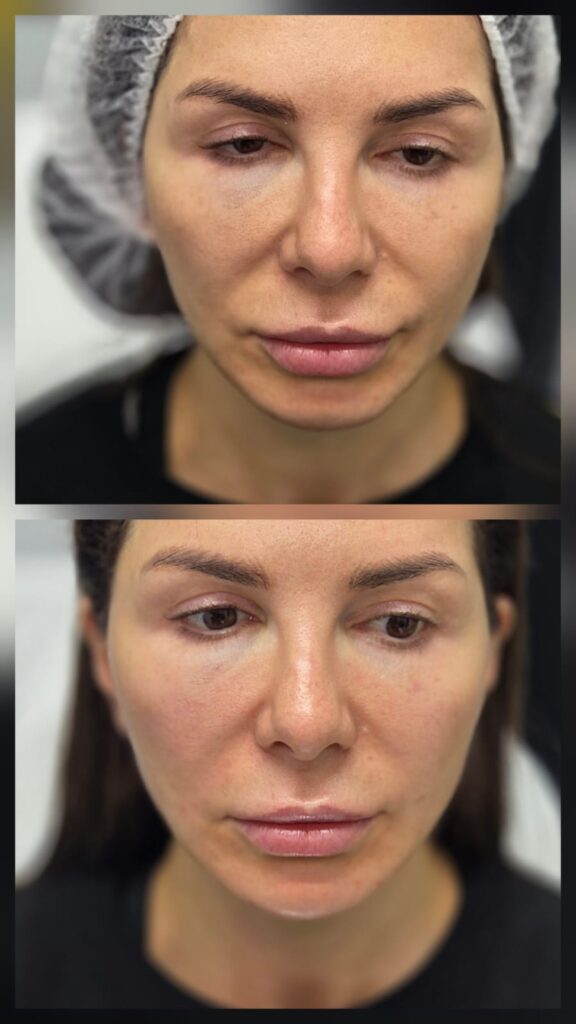 Înainte și după corectarea mentonului și conturarea jawline cu 3 ml la Top Skin București