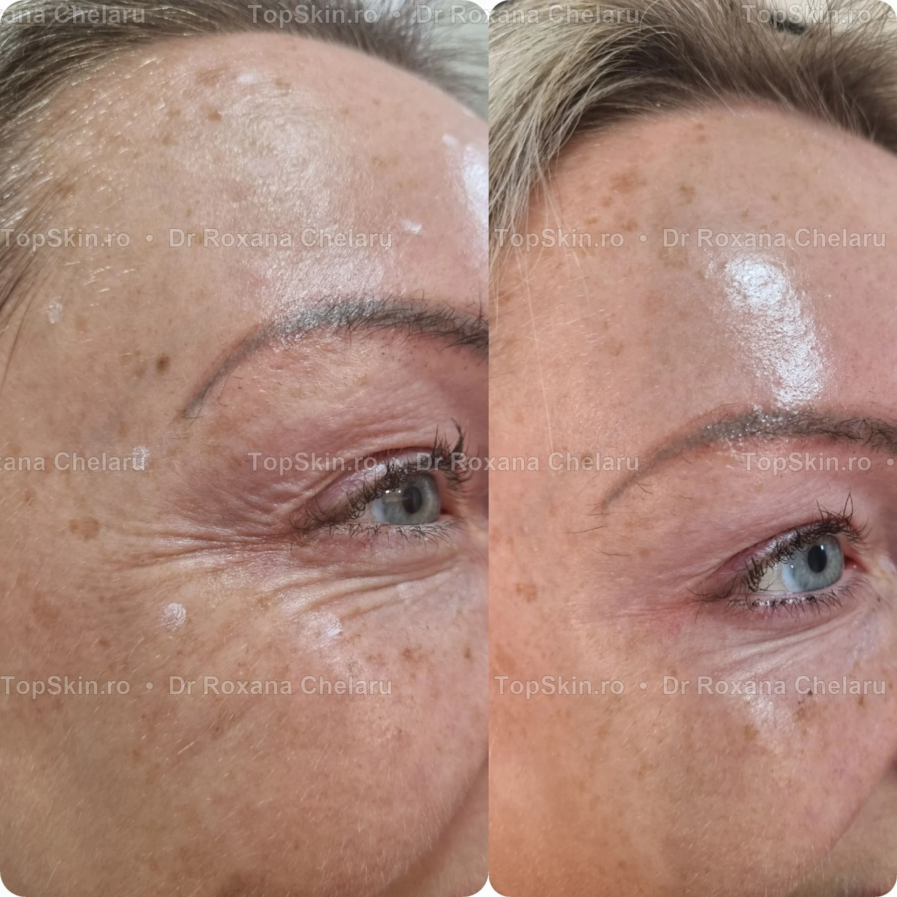 Caz real de tratament al ridurilor laba gastii cu toxina botulinica la TopSkin