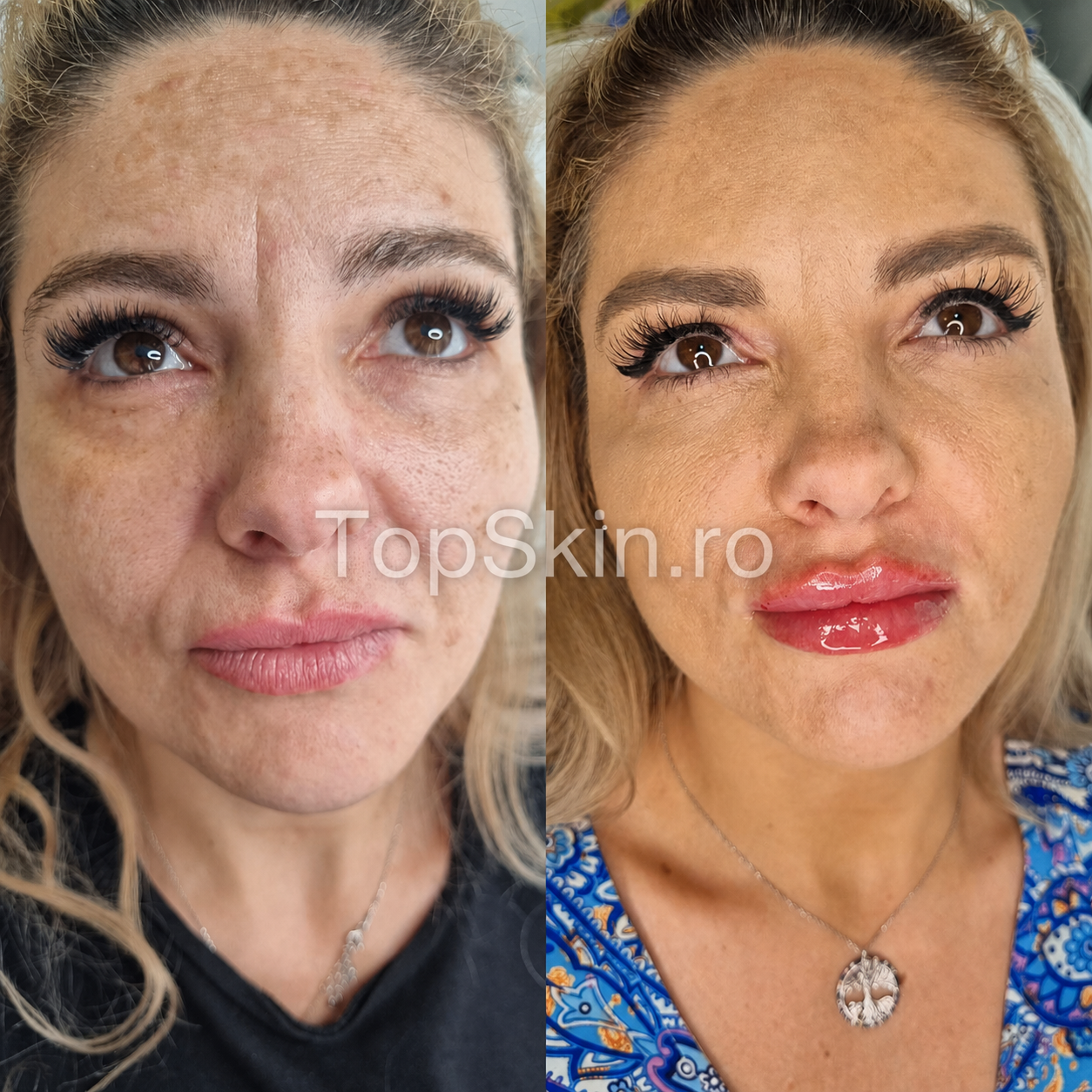Caz real TopSkin inainte si dupa plan facial combinat cu Sculptra laser CO2 si tratamentul buzelor