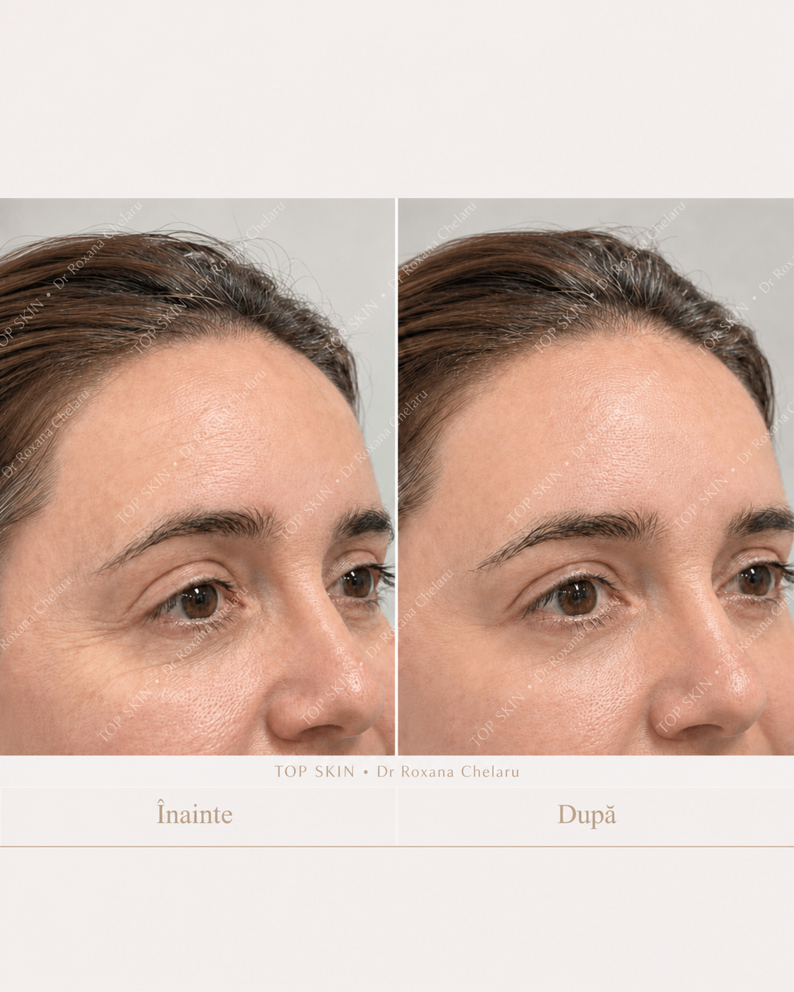 Rezultat Botox înainte și după pentru ridurile din jurul ochilor, realizat la clinica Top Skin de Dr. Roxana Chelaru