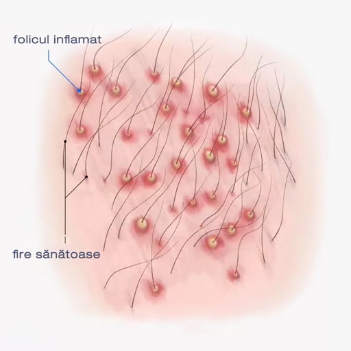 Foliculita scalpului – inflamatie foliculara evaluata dermatologic la Top Skin