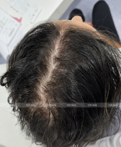 Cărare centrală lărgită și scalp vizibil la nivelul vertexului