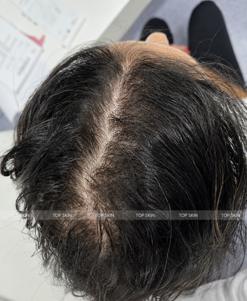 Cărare centrală lărgită și scalp vizibil la nivelul vertexului