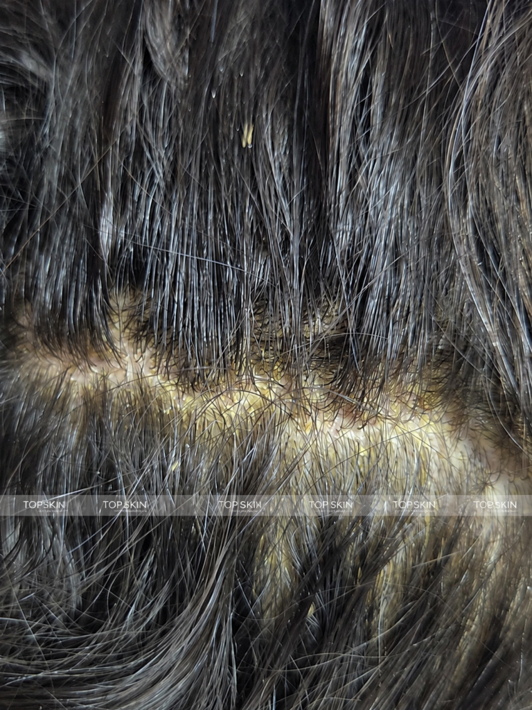 Scalp cu scuame aderente vizibile printre firele de păr