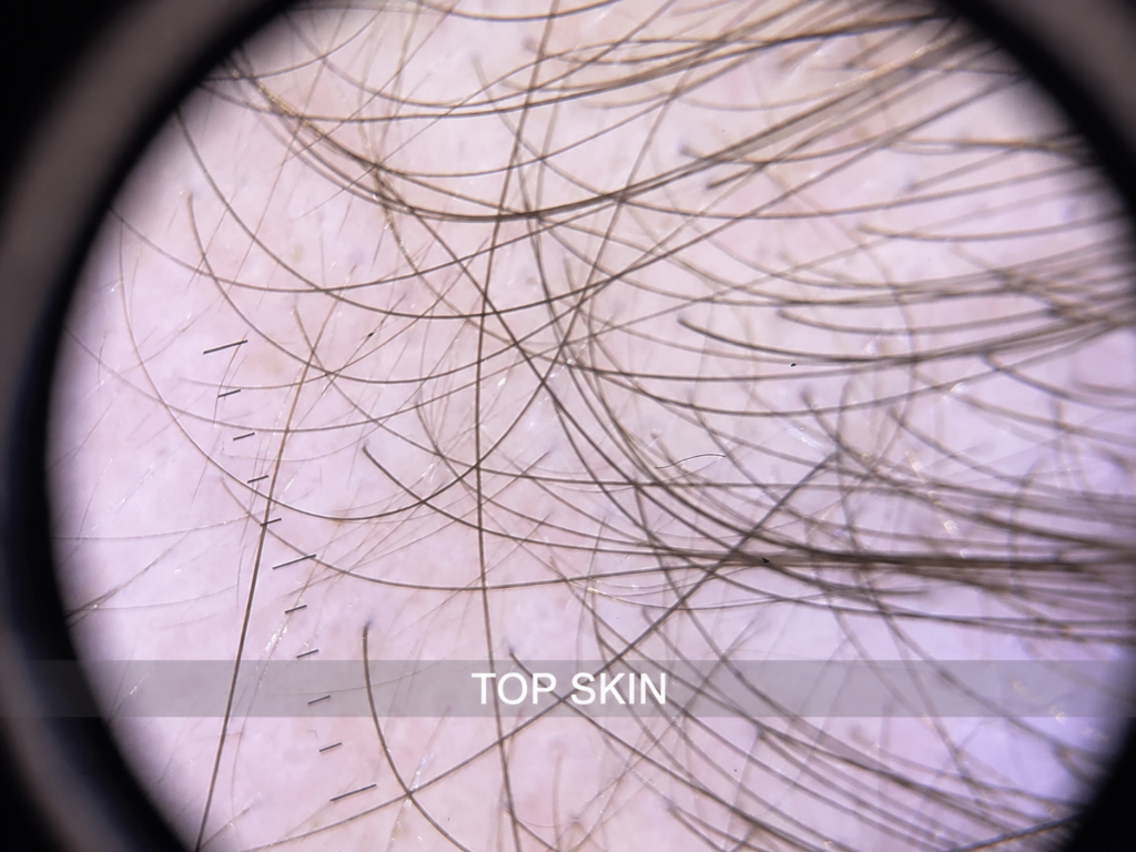 Imagine tricoscopică – rărire temporală - Dr Roxana Chelaru - Dermatologie si Estetica Medicala Bucuresti - Dr Roxana Chelaru - Dermatologie si Estetica Medicala Bucuresti Fire de păr și scalp observate prin mărire tricoscopică