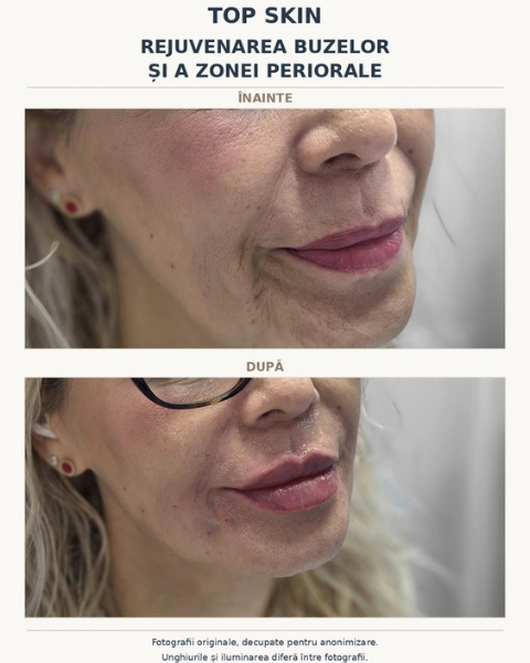 Rejuvenare buze și zonă periorală – înainte și după – Top Skin - Dr Roxana Chelaru - Dermatologie si Estetica Medicala Bucuresti - Dr Roxana Chelaru - Dermatologie si Estetica Medicala Bucuresti Rejuvenare buze și zonă periorală – fotografii înainte și după anonimizate, în condiții diferite de lumină și unghi